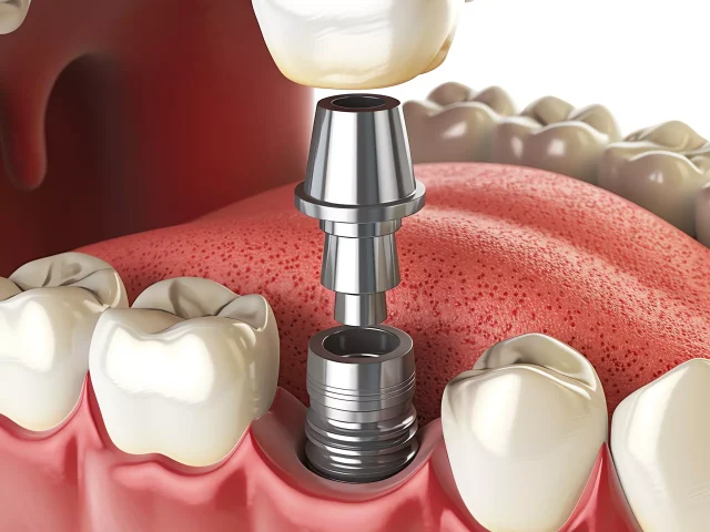 Implants