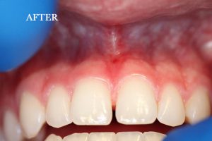 Frenectomy Patient 1 after treatment