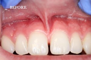 Frenectomy Patient 1 before treatment