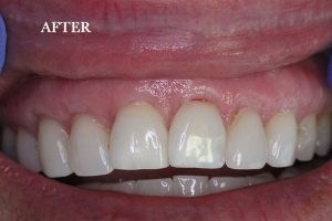 Gum Graft Patient 1 after treatment