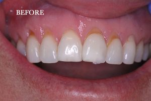 Gum Graft Patient 1 before treatment
