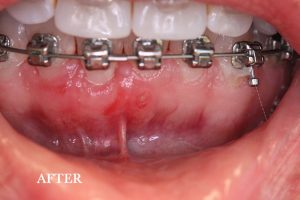 Gum Graft Patient 2 after treatment