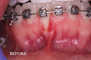 Gum Graft Patient 2 before treatment