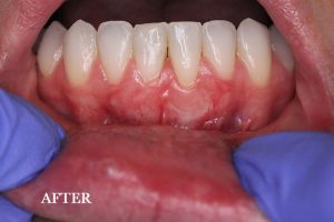 Gum Graft Patient 3 after treatment