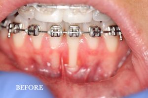 Gum Graft Patient 3 before treatment