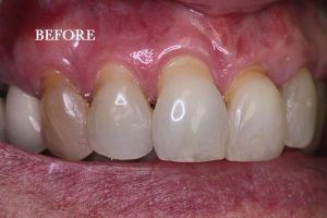 Gum Graft Patient 4 before treatment