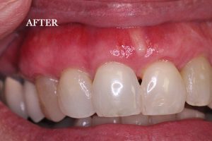Gum Graft Patient 4 after treatment