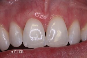 Gum Graft Patient 5 after treatment