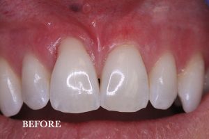 Gum Graft Patient 5 before treatment