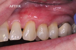 Gum Graft Patient 6 after treatment