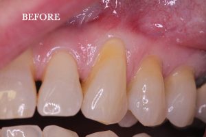 Gum Graft Patient 6 before treatment
