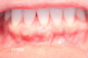 Gum Graft Patient 7 after treatment