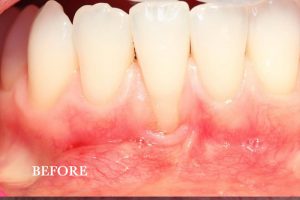 Gum Graft Patient 7 before treatment