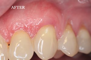 Gum Graft Patient 8 after treatment