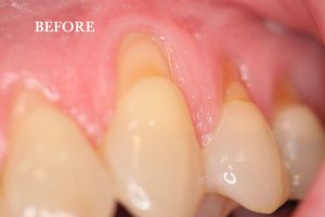 Gum Graft Patient 8 before treatment