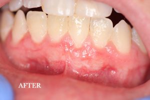 Gum Graft Patient 9 after treatment