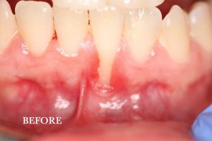Gum Graft Patient 9 before treatment
